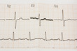 Arrhythmia