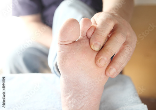 Photo: dry skin on the foot of a man dry skin on the foot of a man