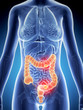 3d rendered illustration of colon cancer
