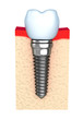 Illustration: Dental implant in jaw bone Dental implant in jaw bone