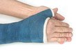 Photo: Broken wrist, arm with a blue fiberglass cast Broken wrist, arm with a blue fiberglass cast