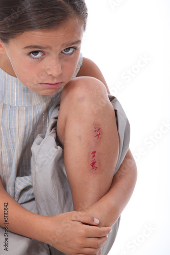 Photo: Little girl with grazed knee Little girl with grazed knee