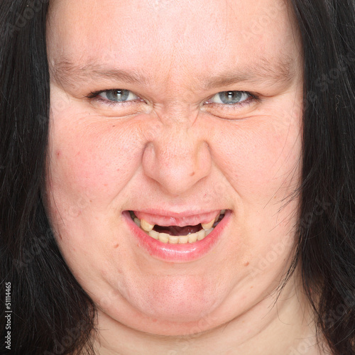Photo: Obese woman with missing teeth. Obese woman with missing teeth.
