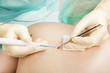 Dermatologist removes mole electrocoagulation method.