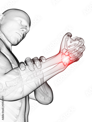 Illustration: 3d rendered medical illustration - painful wrist 3d rendered medical illustration - painful wrist