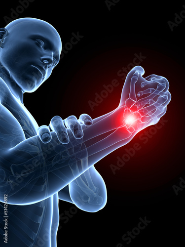 Illustration: 3d rendered medical illustration - painful wrist 3d rendered medical illustration - painful wrist