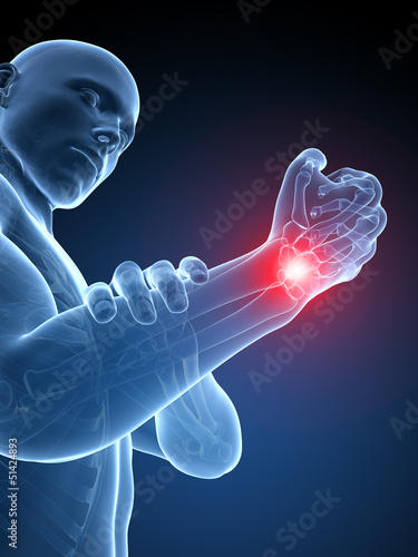 Illustration: 3d rendered medical illustration - painful wrist 3d rendered medical illustration - painful wrist