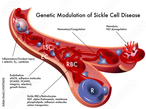 Vector: Modulazione genetica anemia falciforme Modulazione genetica anemia falciforme