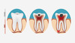Tooth decay