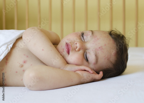 Photo: Child with chicken pox Child with chicken pox