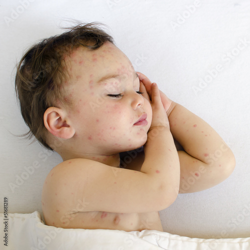 Photo: Child with chicken pox Child with chicken pox