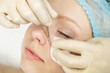 Blackhead Removal Tool.