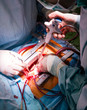 Cardiac surgery