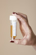 Sterile plastic bottle containing a urine sample