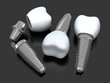 Three Dental implant