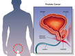 Vector: cancro della prostata cancro della prostata