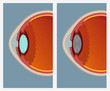 Cataract