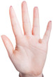 Warze an einer Hand