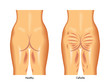 cellulite