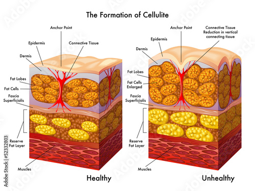 Vector: formazione della cellulite formazione della cellulite