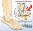 Illustration: Außenbandriss, gerissenes Kreuzband am Fuss Außenbandriss, gerissenes Kreuzband am Fuss