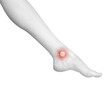 Healing blister on the foot ankle.