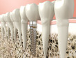 Illustration: Dental implant Dental implant