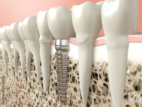 Illustration: Dental implant Dental implant
