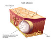 ciste sebacea