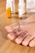 Wounds on women foot