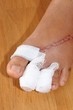 Wounds on women foot
