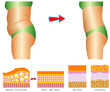Cellulite - Woman's body before and after.