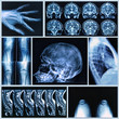 Radiography of Human Bones