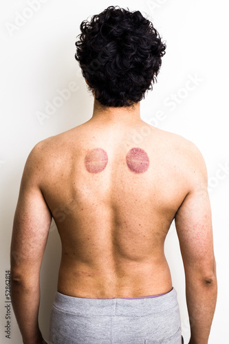 Photo: Rear view of man with marks from cupping therapy Rear view of man with marks from cupping therapy
