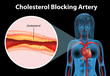 Ateriosclerosis