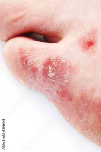 Photo: Athlethe's Foot Athlethe's Foot