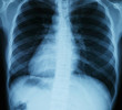 Chest xray scan