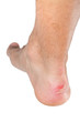 Ankle of male man with scratch