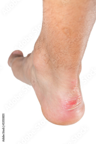 Photo: Ankle of male man with scratch Ankle of male man with scratch