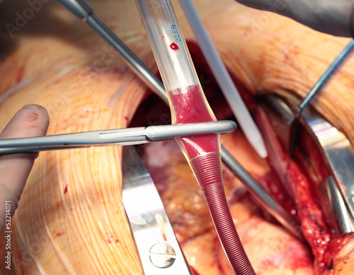 Photo: Operating incision and surgical instruments Operating incision and surgical instruments