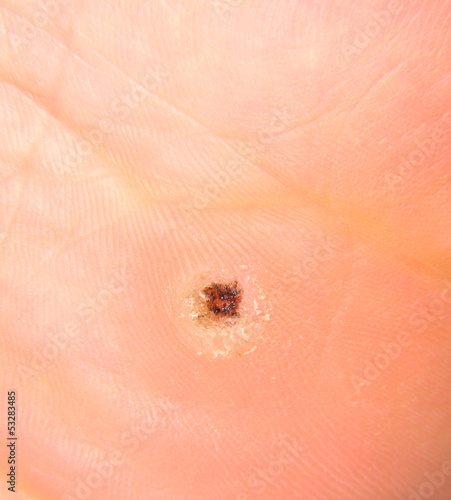 Photo: Black spotted callus under a human foot Black spotted callus under a human foot