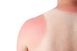 sonnenbrand