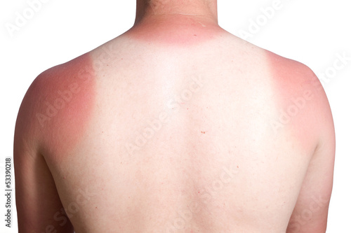 Photo: sunburn sunburn