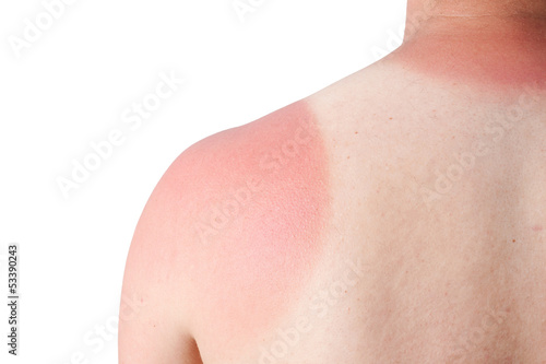 Photo: sonnenbrand sonnenbrand