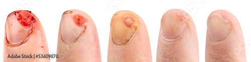 Photo: Healing of cut finger, five images isolated on white Healing of cut finger, five images isolated on white