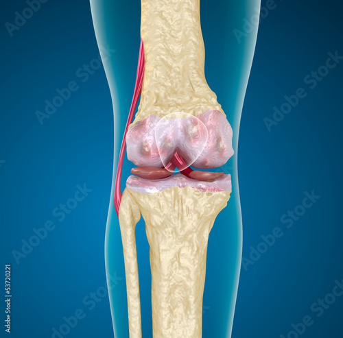 Illustration: Osteoporosis of the knee joint. Osteoporosis of the knee joint.