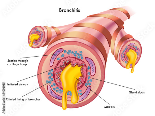 Vector: bronchite bronchite