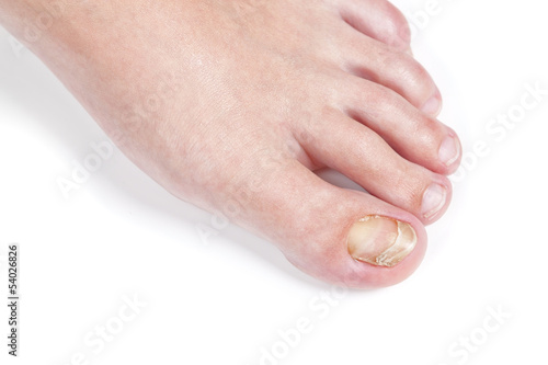 Photo: Skin fungus on the nail, on the female foot. Close-up. Skin fungus on the nail, on the female foot. Close-up.