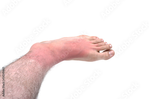 Photo: Sunburn feet Sunburn feet