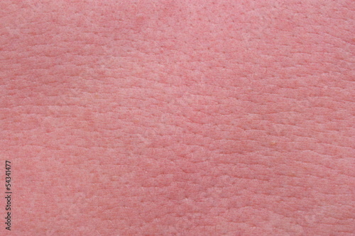 Photo: Strong sunburn skin Strong sunburn skin